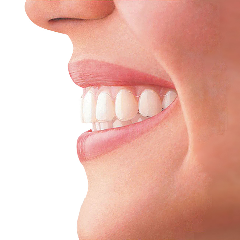 Neviditeľné zubné strojčeky Invisalign
