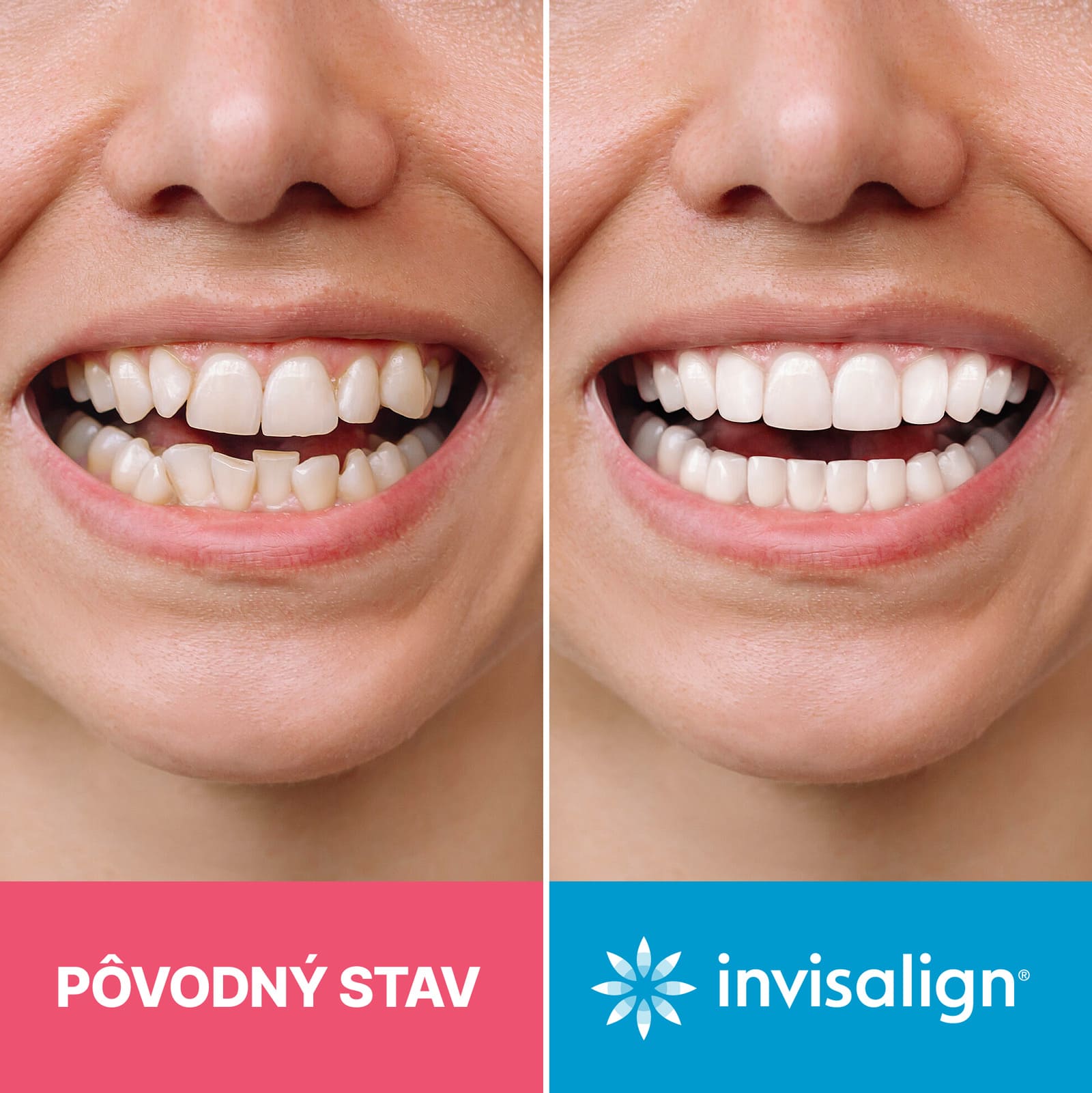 Liečba Invisalign pred a po