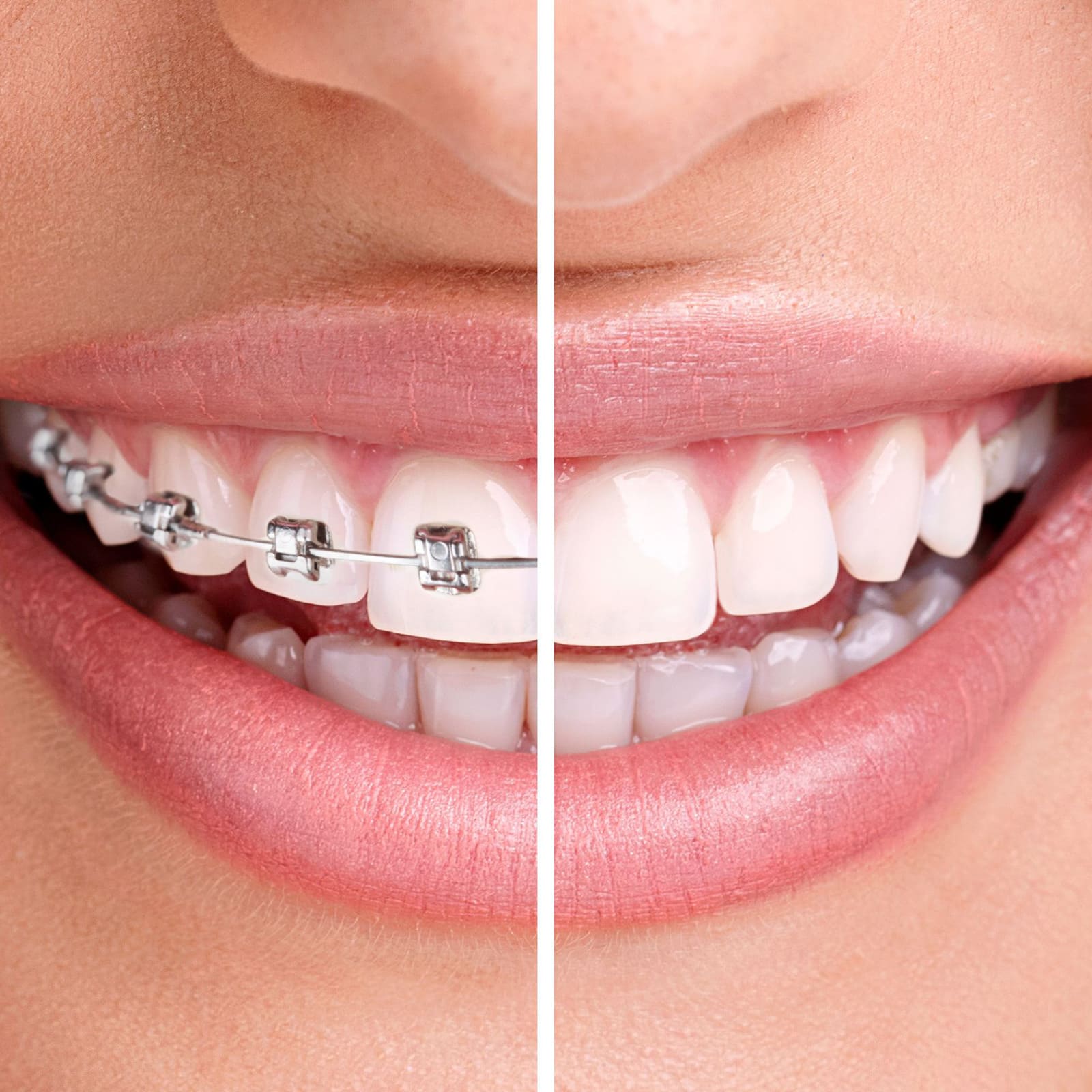 Neviditeľné zubné strojčeky Invisalign - porovnanie s klasickým strojčekom